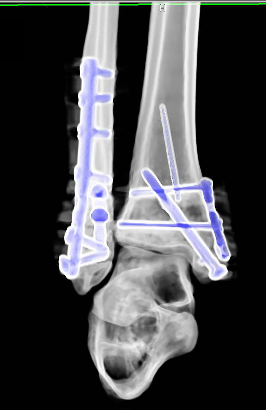 Open Reduction Internal Fixation Orif Of Tibia And Fibular Fractures Musculoskeletal Case