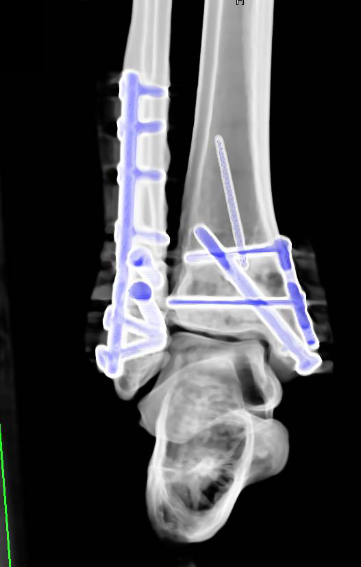 open tib fib fracture x ray