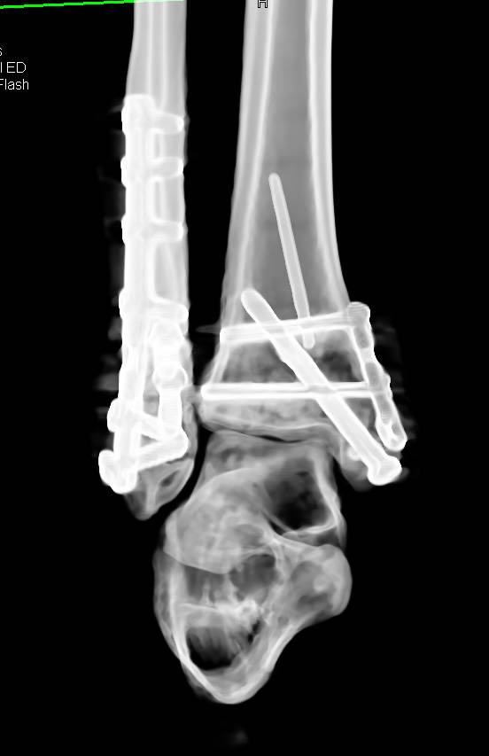 comminuted open fracture tibia fibula