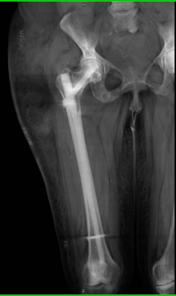 Intramedullary Rod Femur - CTisus CT Scan