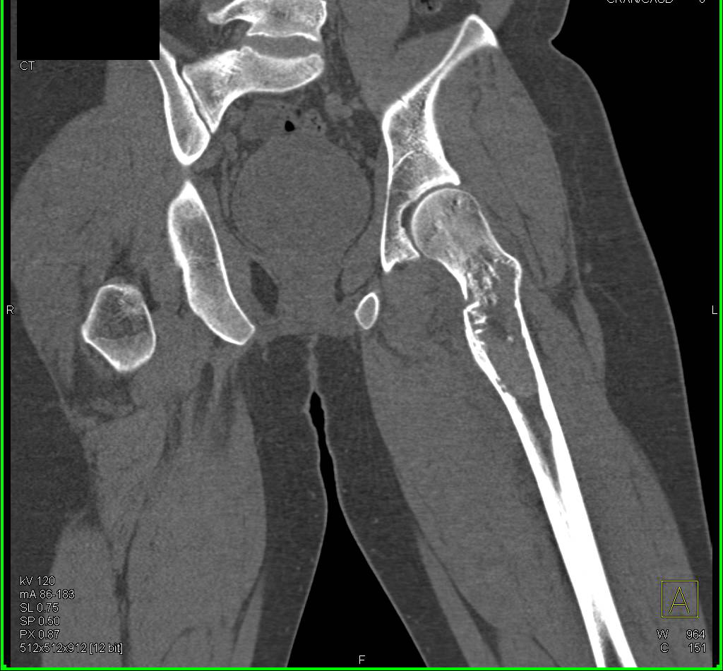 Fracture Through a Bone Cyst in the Left Femur - CTisus CT Scan