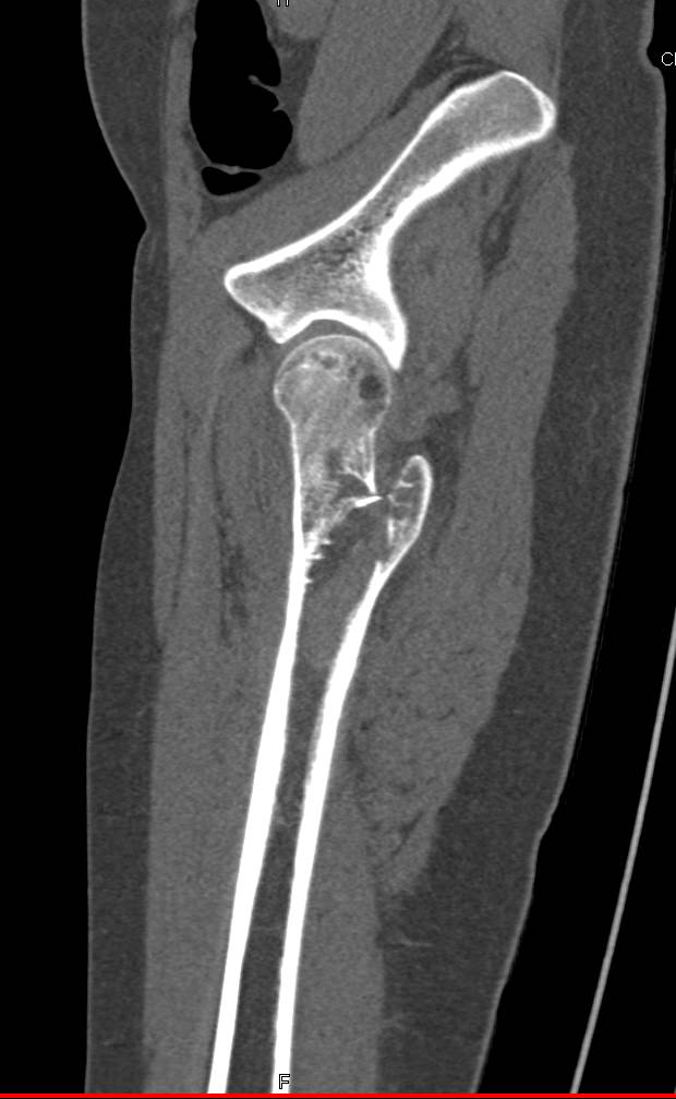 Fracture Through a Bone Cyst in the Left Femur - CTisus CT Scan