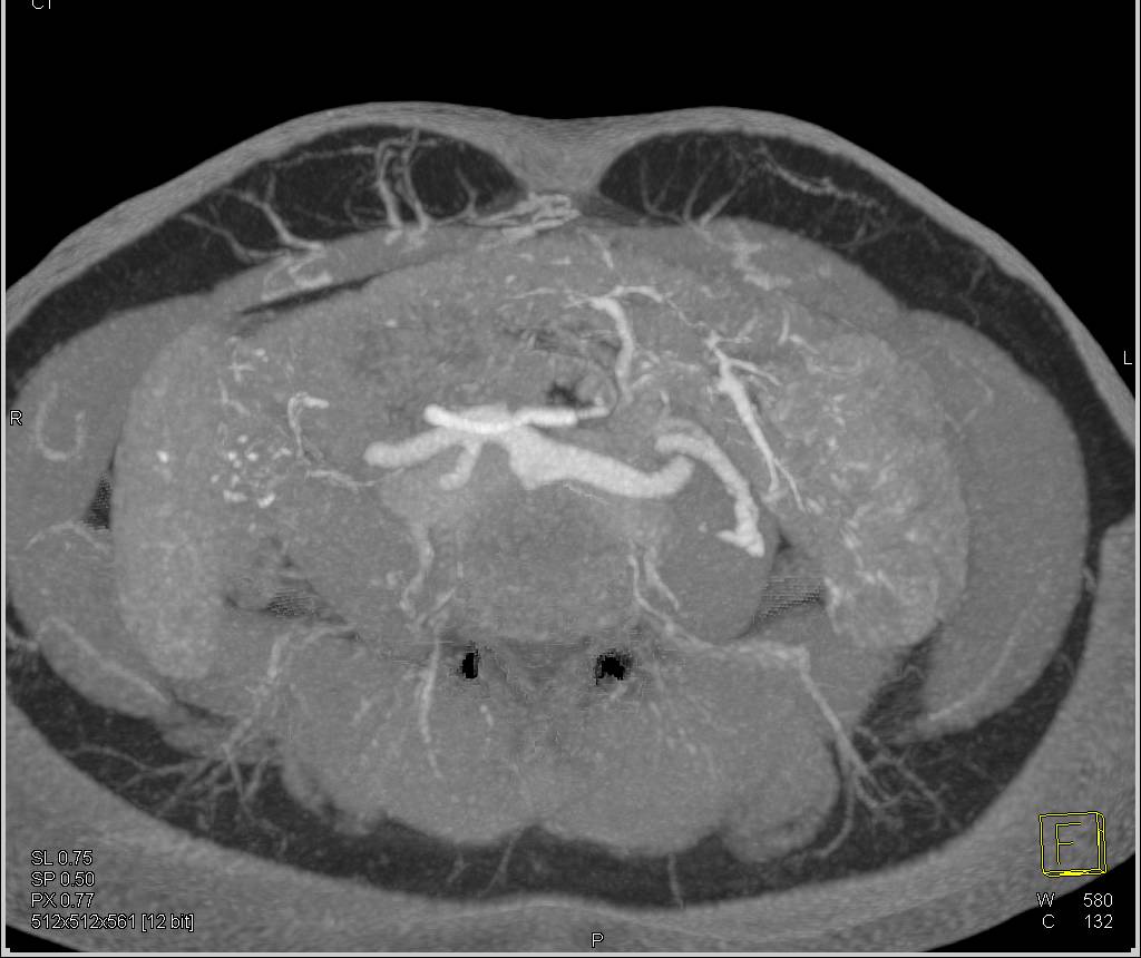 DIEP Flap Planning for Breast Reconstructive Surgery - Musculoskeletal Case  Studies - CTisus CT Scanning