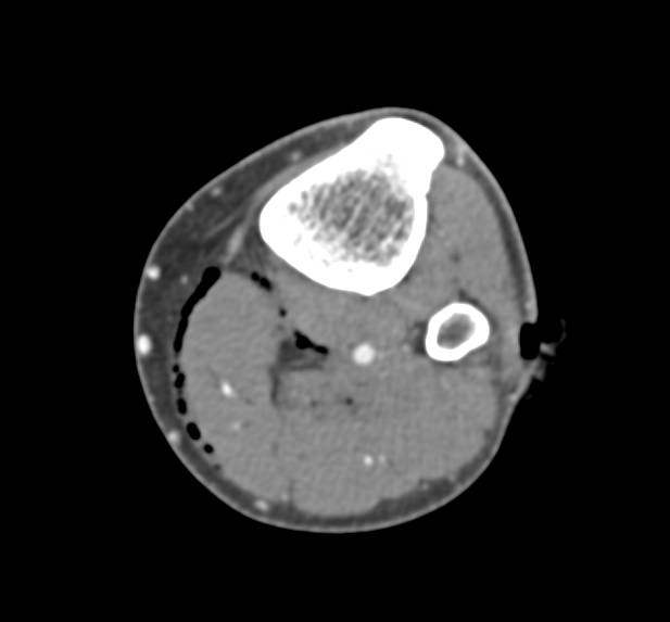 CTA Following GSW Without Active Bleed - CTisus CT Scan