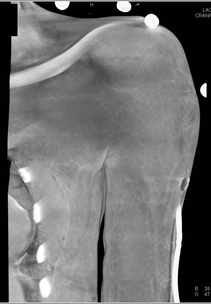 Metastatic Breast Cancer to Bone - CTisus CT Scan