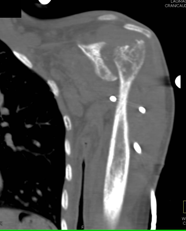 Metastatic Disease to Humerus - CTisus CT Scan