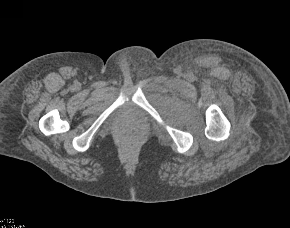 Myositis Left Adductor Magnus - CTisus CT Scan