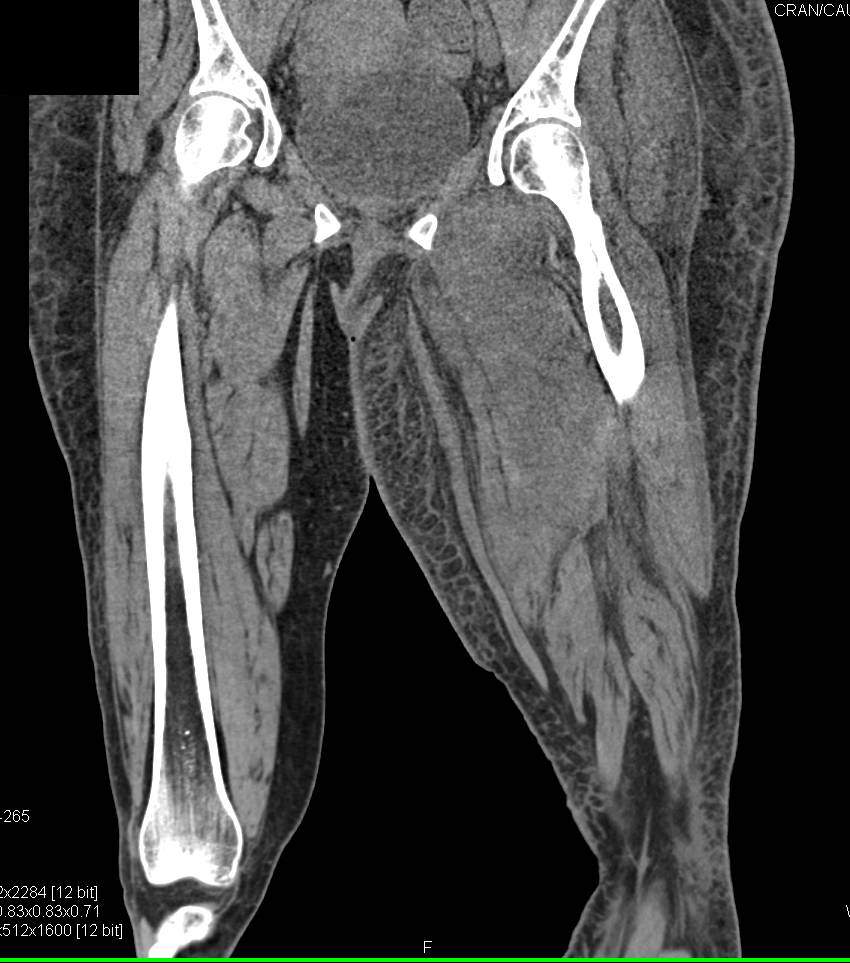 Myositis Left Adductor Magnus - CTisus CT Scan