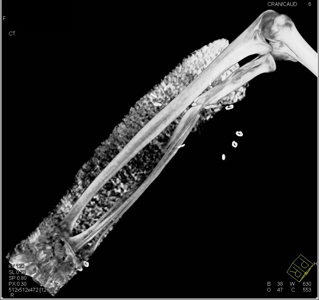 Radius Fracture in Cast - CTisus CT Scan