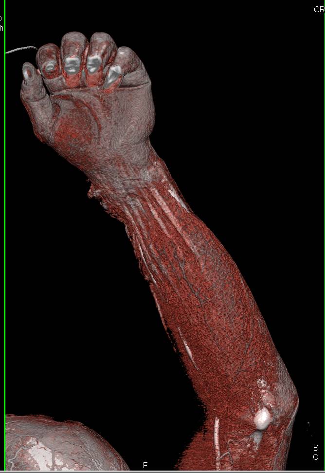 3D Of Forearm Trauma with Soft Tissue Injury - CTisus CT Scan