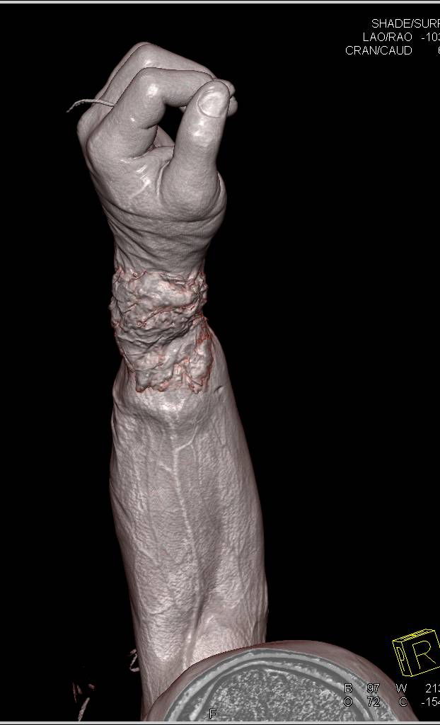 3D Of Forearm Trauma with Soft Tissue Injury - CTisus CT Scan