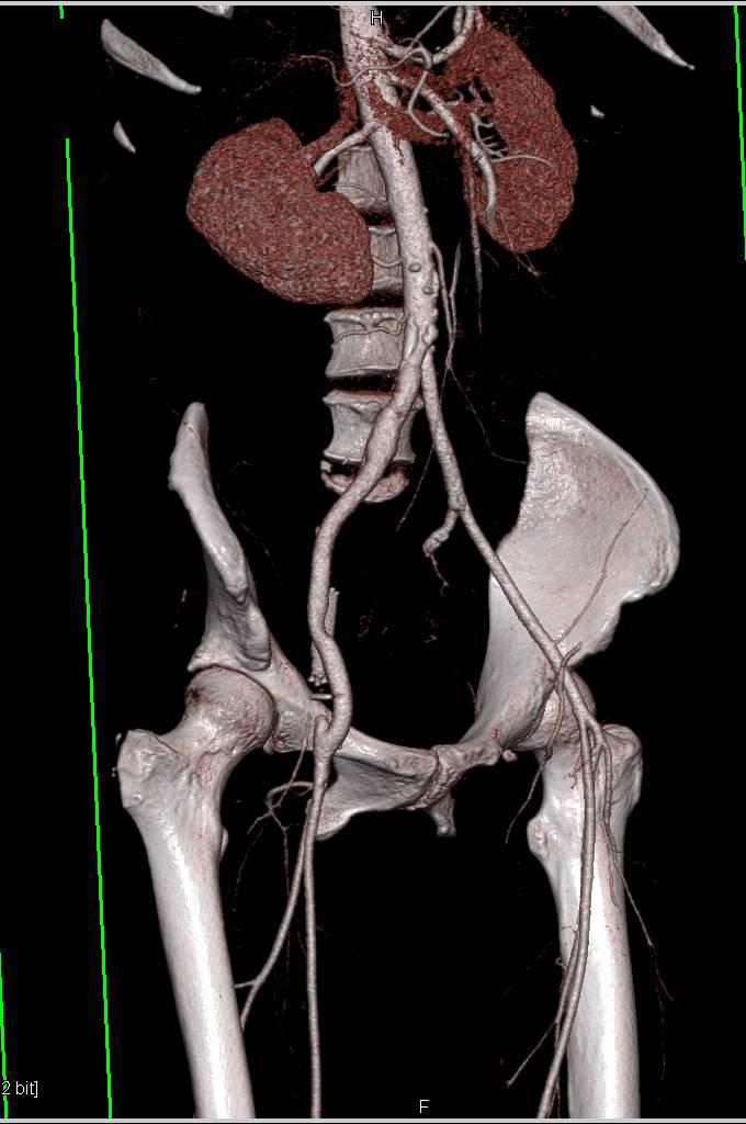 Dual Energy with Bone Removal - CTisus CT Scan