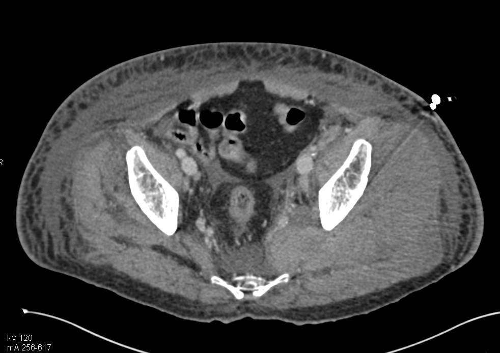 Cellulitis and Myositis Left Thigh and Buttocks - CTisus CT Scan