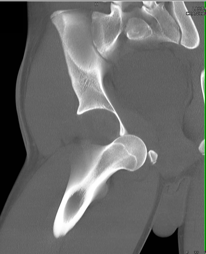 Dislocation of Right Femur - CTisus CT Scan