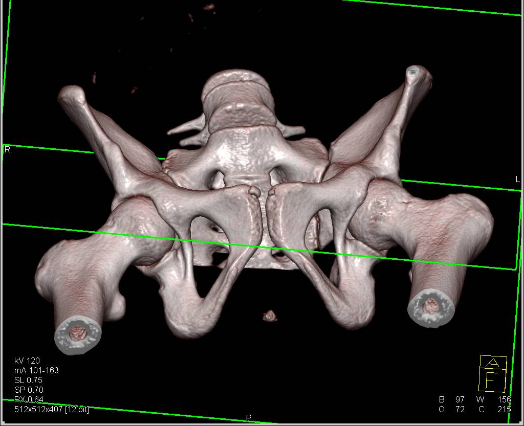 3D Mapping of the Pelvis and Acetabulum - CTisus CT Scan