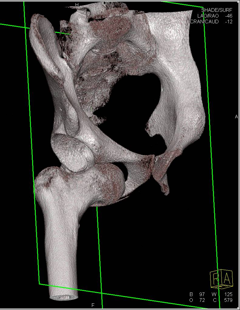 Right Hip Dislocation in 3D - CTisus CT Scan