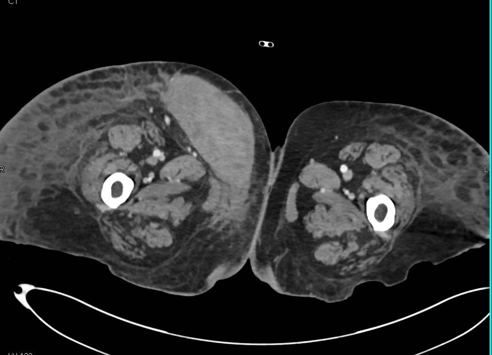 Thigh Hematoma s/p Vascular Procedure - CTisus CT Scan