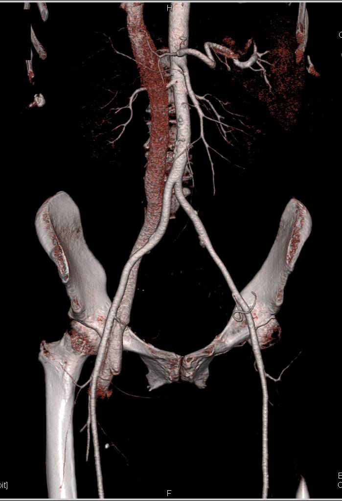 Early Venous Filling with Arteriovenous (AV) Shunt Following Invasive Procedure - CTisus CT Scan