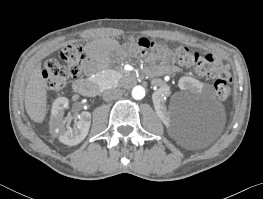 Multiple Skin Nodules Which was Lymphoma - CTisus CT Scan