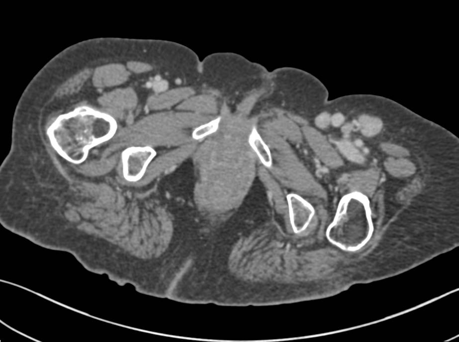 Lymphoma with Extensive Adenopathy - CTisus CT Scan