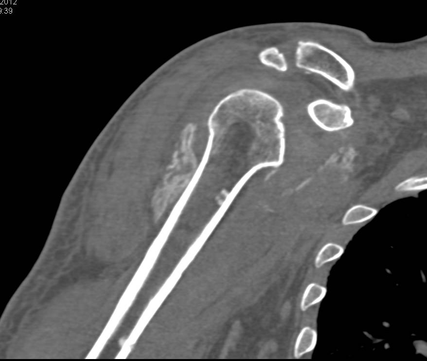 Heterotopic Calcification Right Shoulder - CTisus CT Scan