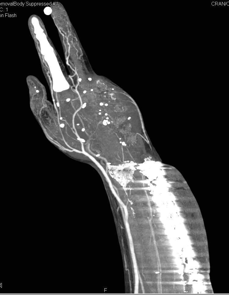 3D Mapping of the Hand and Forearm in Patient with Prior trauma and Repair - CTisus CT Scan