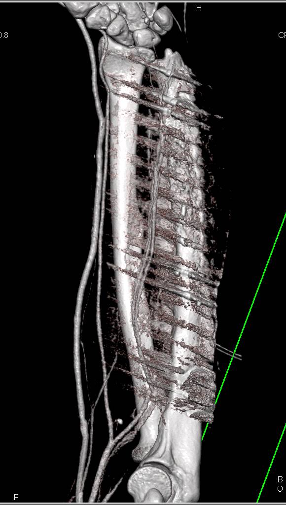 CTA Following Repair of GSW to Forearm and Hand - CTisus CT Scan