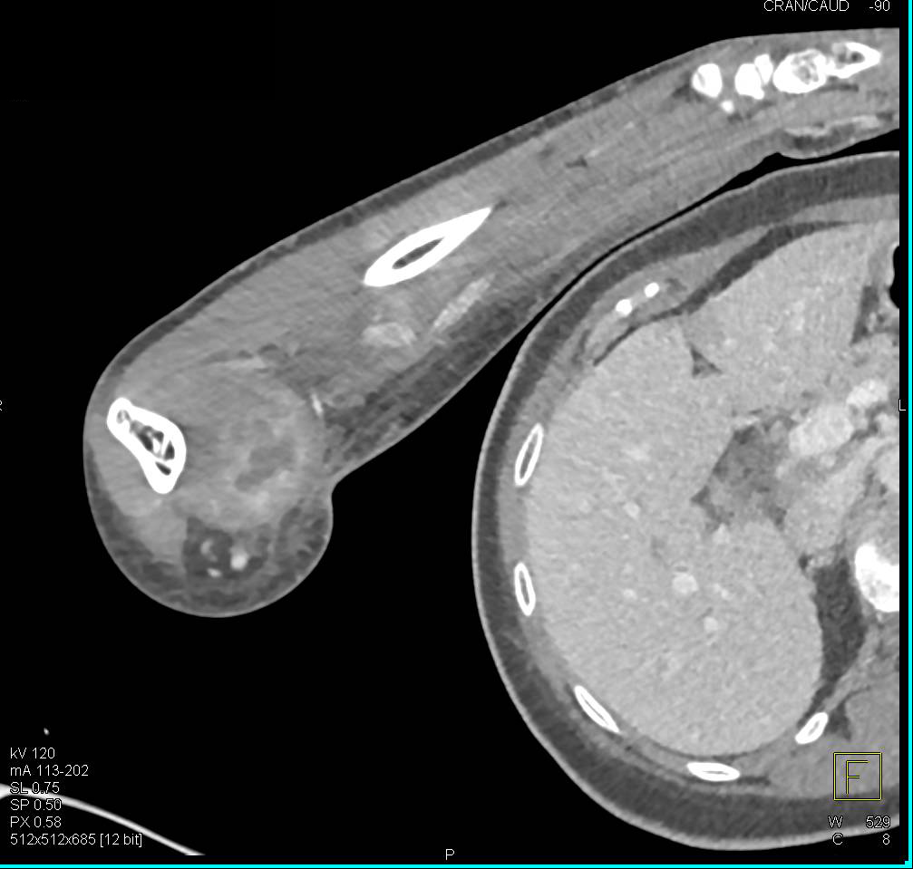 Abscess in Antecubital Fossa - CTisus CT Scan