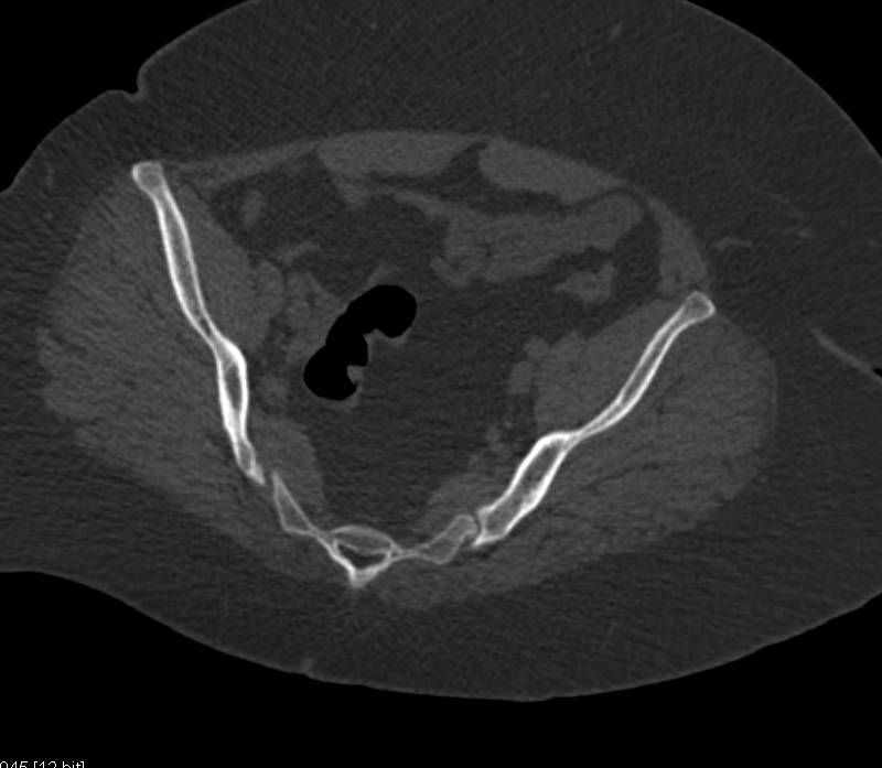 Fibrous Dysplasia - CTisus CT Scan