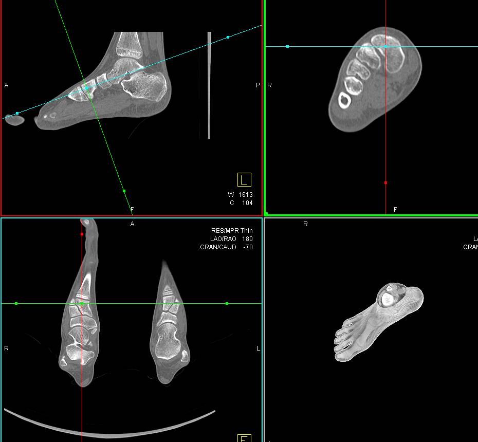 3D Mapping of Pes Planus Deformity - CTisus CT Scan