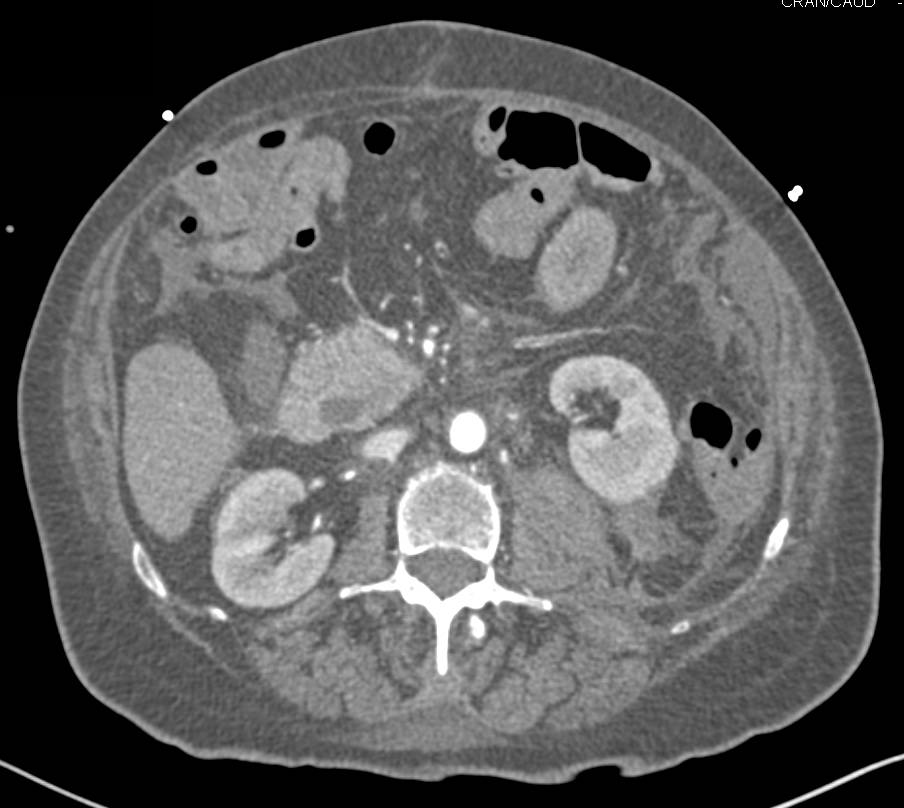 Active Bleed in Left Psoas Muscle and in the Left Upper Quadrant and Pelvis - CTisus CT Scan