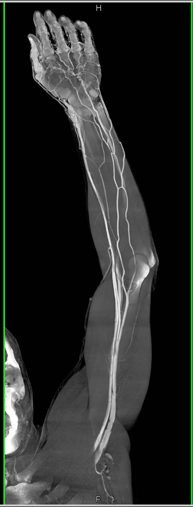 CTA Upper Extremity s/p Trauma - CTisus CT Scan