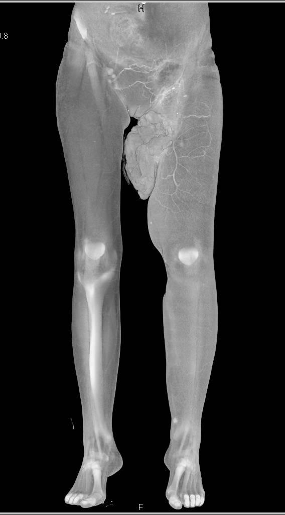 Ulcerating Sarcoma Right Inner Thigh - CTisus CT Scan