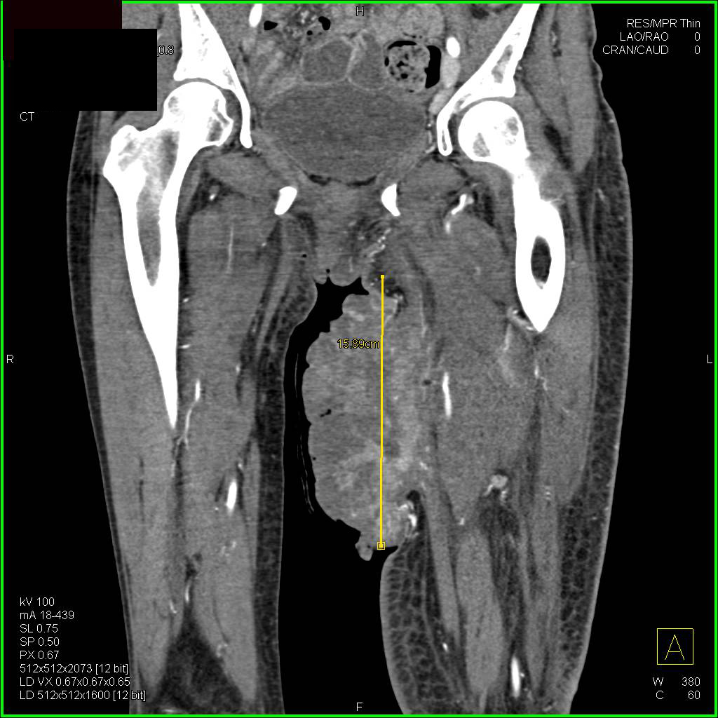 Ulcerating Sarcoma Right Inner Thigh with CTA - CTisus CT Scan