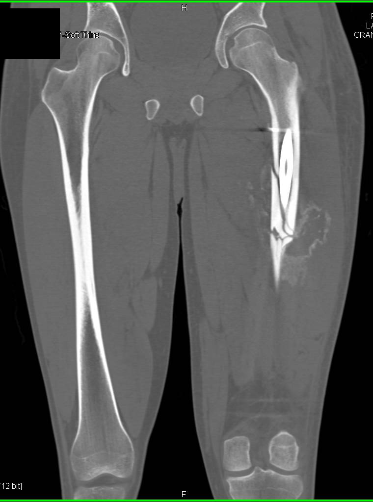 Heterotopic Ossification Near Healing Femur Fracture - CTisus CT Scan