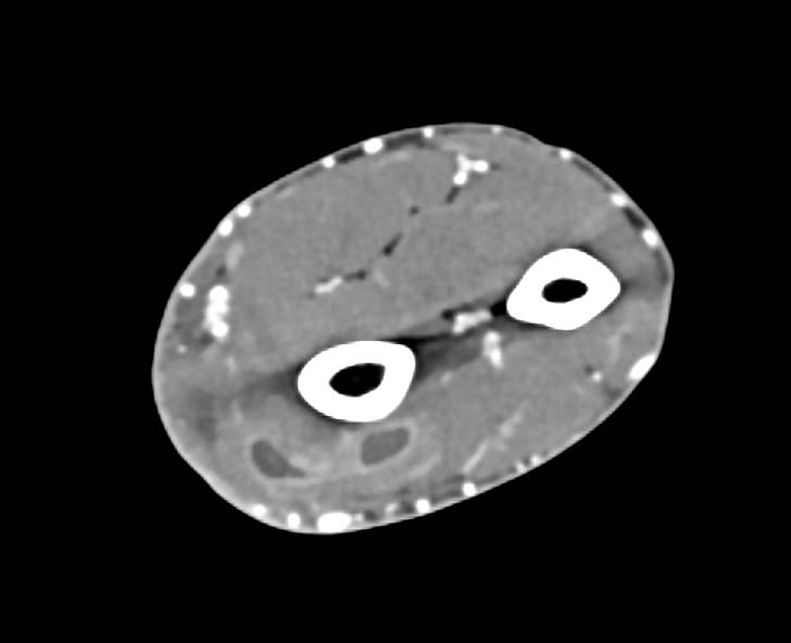 Abscess in Forearm with CTA and 3D - CTisus CT Scan