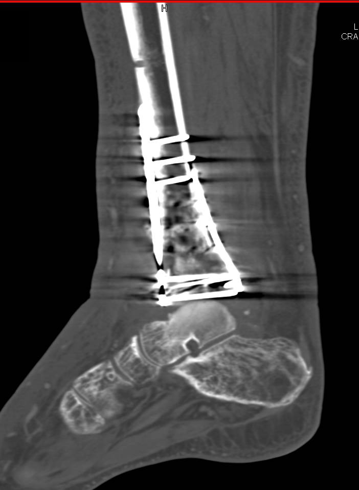 Post Repair of Tibial Injury - CTisus CT Scan