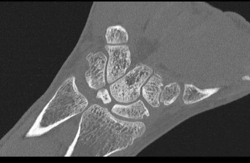 Cystic Changes in the Carpal Bones - CTisus CT Scan