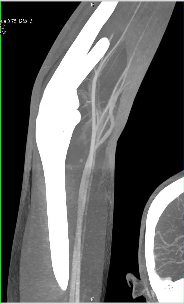 Abscess Near Elbow Joint with CTA and 3D - CTisus CT Scan