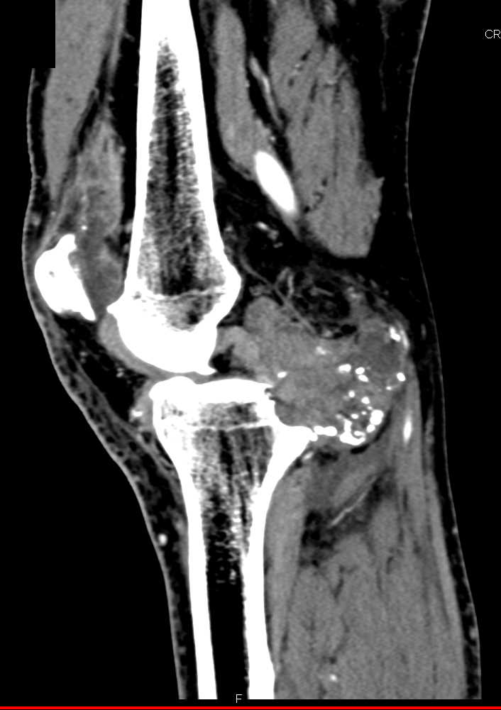 Synovial Chondromatosis Knee Joint - CTisus CT Scan