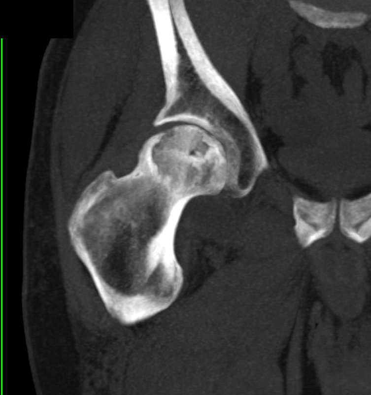 Avascular Necrosis (AVN) Right Femur with Early Fracture Through Articular Surface - CTisus CT Scan