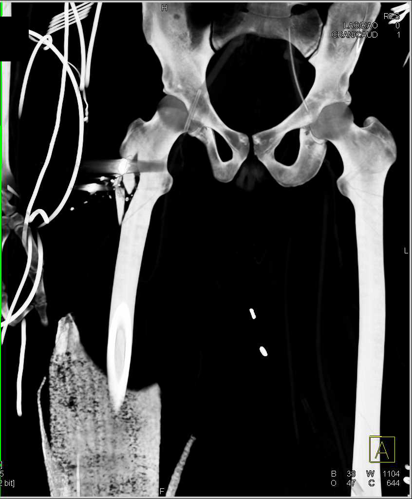 GSW with Femur Fracture but No Vascular Injury - CTisus CT Scan