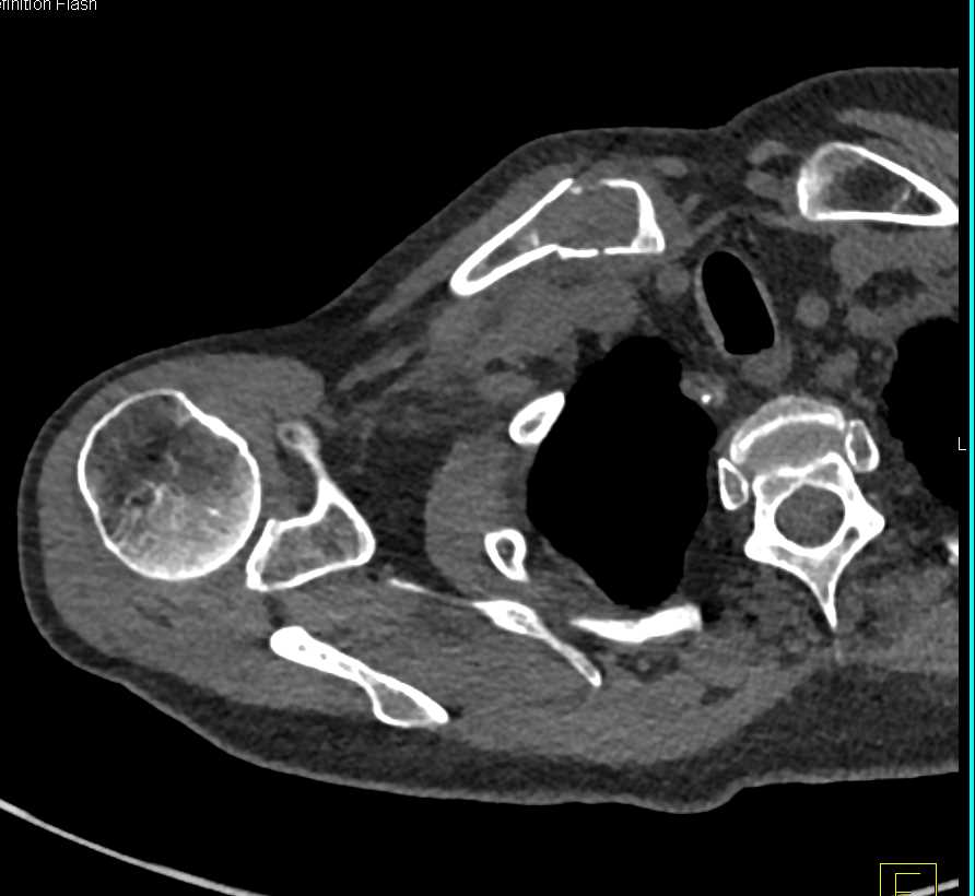 Fracture Through Bone Cyst in Clavicle - CTisus CT Scan