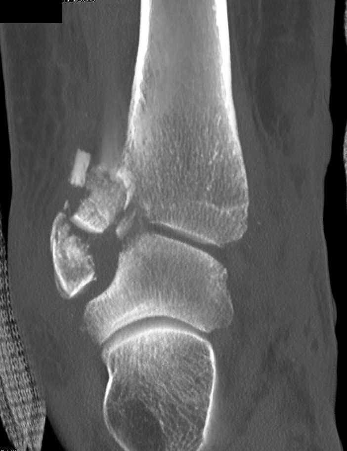 Comminuted Fracture Dislocation at Ankle Joint - CTisus CT Scan