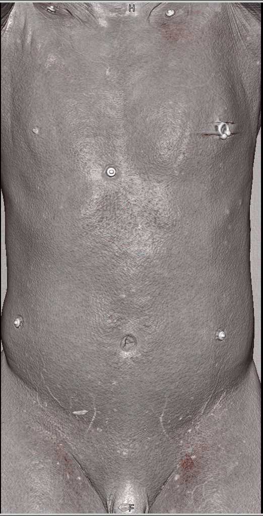 3D of Subcutaneous Nodules due to Lymphoma (Unusual Form) - CTisus CT Scan