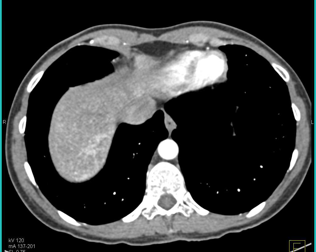 Plasmacytoma Left Iliac Wing - CTisus CT Scan