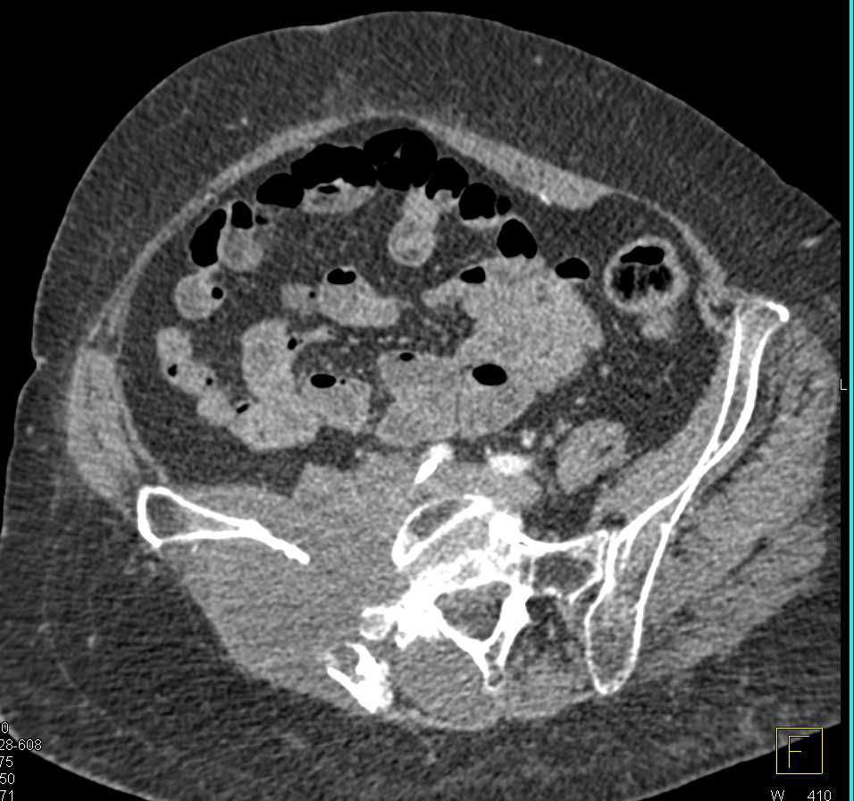 Iliac Wing Fracture Through Pathologic Bone - CTisus CT Scan