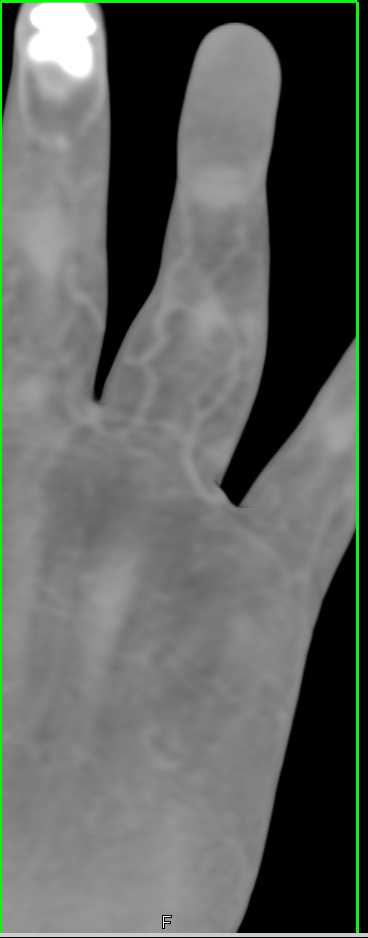 Osteoid Osteoma Finger with Periosteal Reaction - CTisus CT Scan