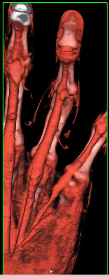 Osteoid Osteoma Finger with Periosteal Reaction - CTisus CT Scan