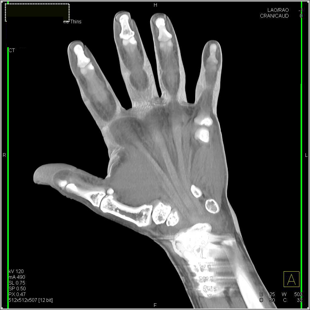 3D Hand Showing Ligaments and Post Radial Fracture Repair - CTisus CT Scan